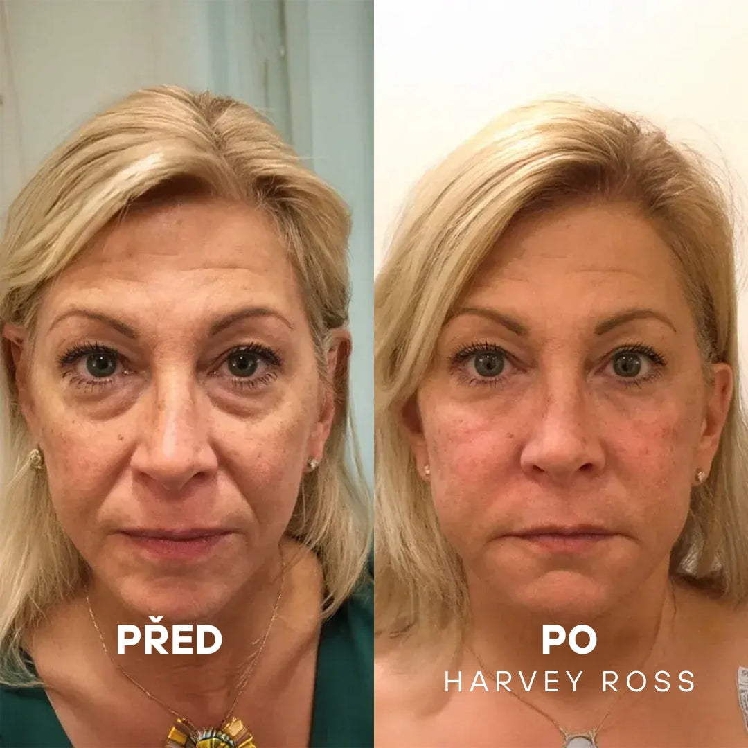 Harvey Ross - Instant Lift+